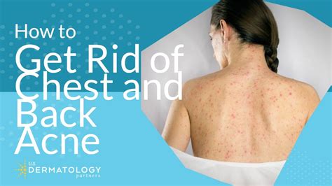 What should I wear for back acne?