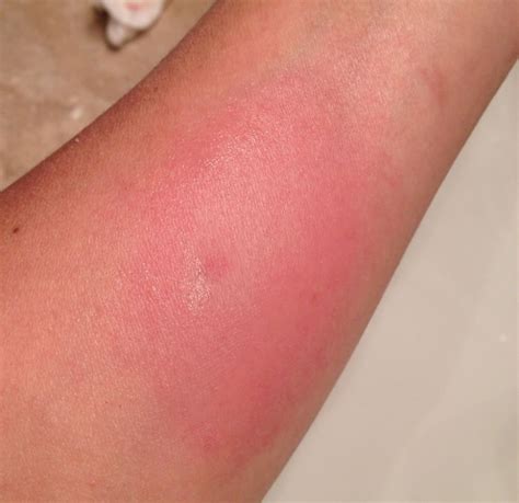 What should a bee sting look like after a few days?