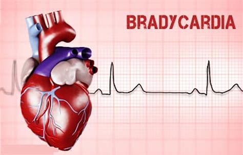 What should people with bradycardia avoid?