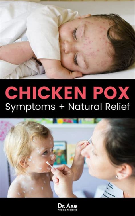 What should you do if you come in contact with chicken pox?