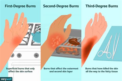 What should you never use to cool a burn?