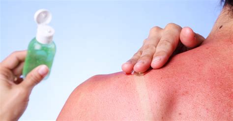 What should you not put on sunburn?