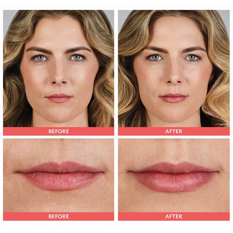 What shouldn't you do after lip fillers?