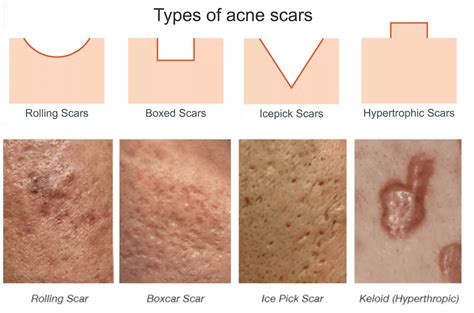 What skin types scar easily?