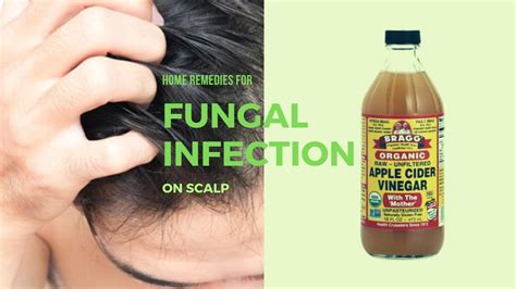 What soap is good for fungal scalp infection?