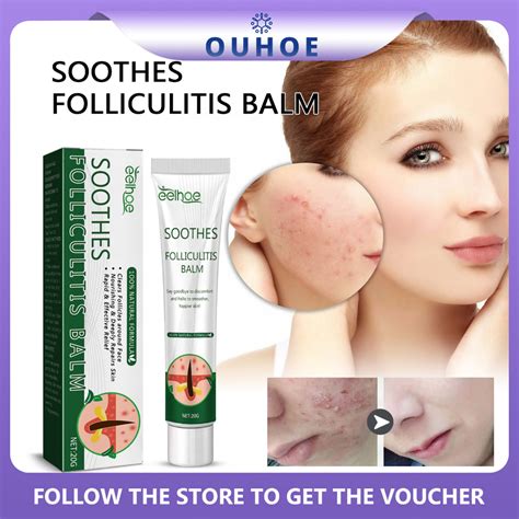 What soothes folliculitis?