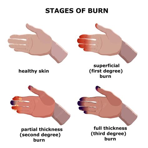 What stage of burn is white?