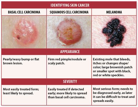 What stage of cancer is aggressive?