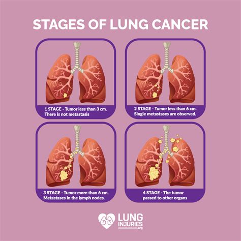 What stage of lung cancer kills you?