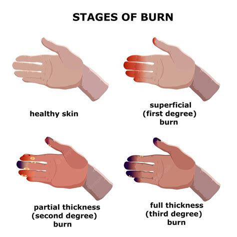 What stages of burns are white?