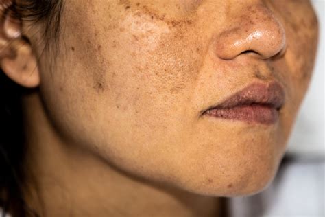What stops hyperpigmentation?