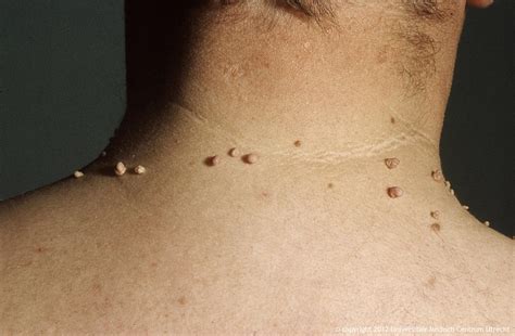 What syndrome has multiple skin tags?