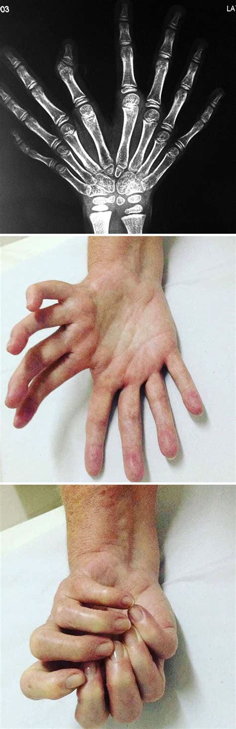 What syndromes have missing fingers?
