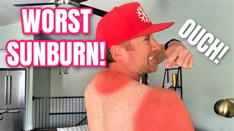 What time of day is worst for sunburn?