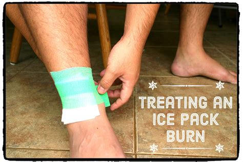 What to do after burn ice?