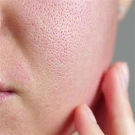 What to do after opening pores with steam?