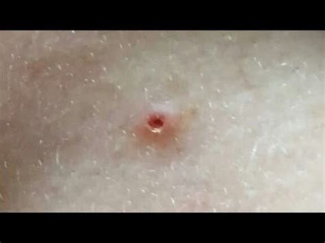 What to do if a pimple leaves a hole?
