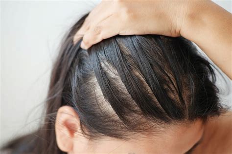 What to do if hair is thinning in the front?