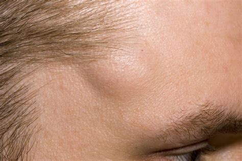 What to do if you have a lump on your cheek?