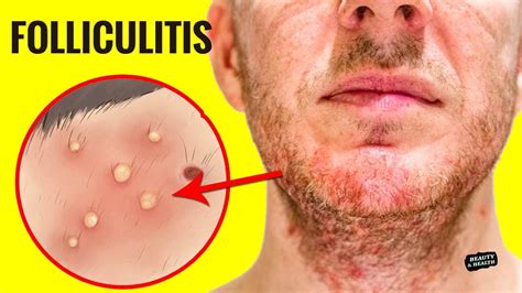 What to do when folliculitis pops?