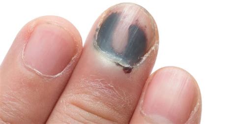 What to do when you smash your fingernail and it turns black?