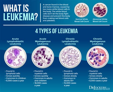 What triggers leukemia?