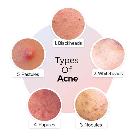 What type of acne leaves holes?