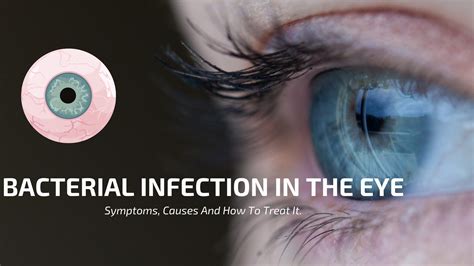 What type of bacteria would cause an eye infection?