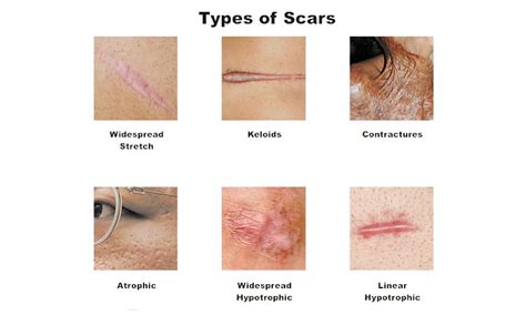 What type of scars never go away?