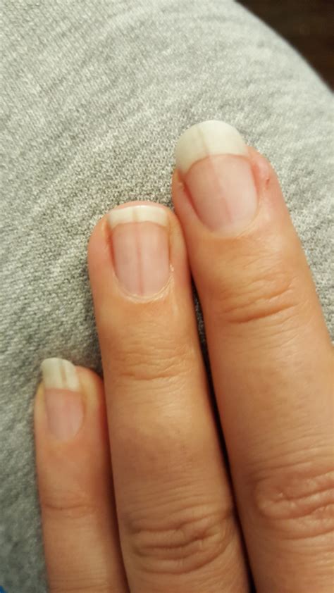 What vitamin deficiency causes dark vertical lines in nails?
