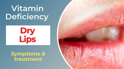 What vitamin deficiency is dry mouth?