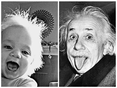 What was Einstein's hair disease?
