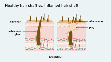 What weakens hair follicles?