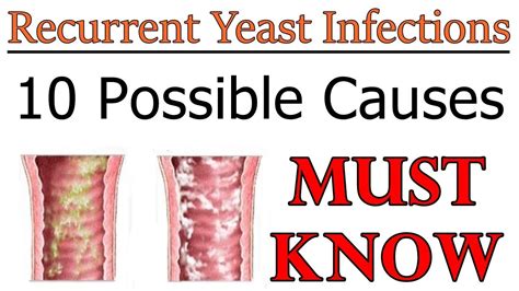 What worsens a yeast infection?