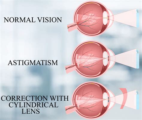 What worsens astigmatism?