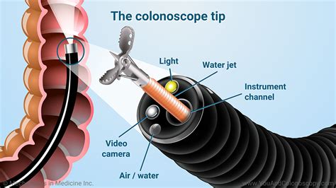 What you Cannot do after colonoscopy?