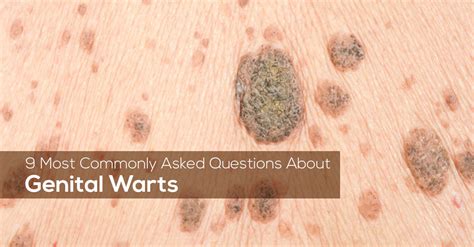 When are genital warts no longer contagious?