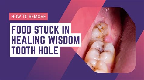 When can I stop worrying about food getting stuck in wisdom teeth holes?