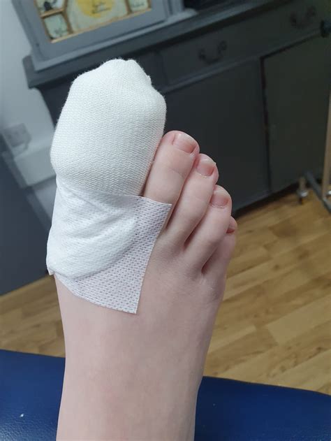 When can I wear socks and shoes after toenail removal?