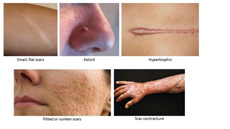 When do scars look their worst?