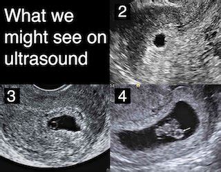 When do you get your first ultrasound?