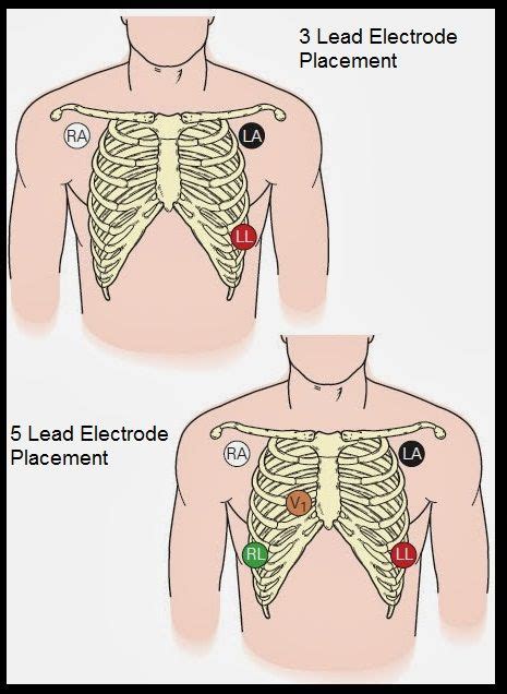 When do you use 3 lead vs 5 lead ECG?