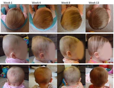 When does baby head shape become permanent?