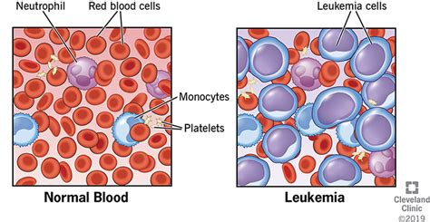 When does leukemia start to show?