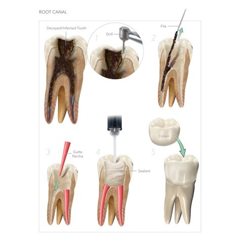 When is it too late for a root canal?
