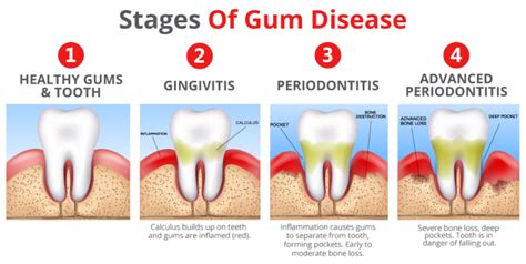 When is it too late for periodontitis?