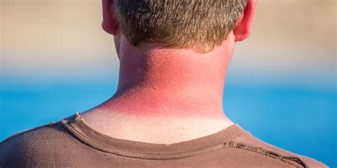 When is sunburn the worst?