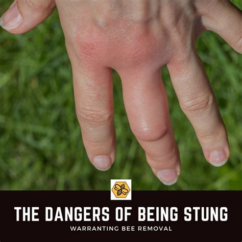 When should I be concerned about a bee sting?