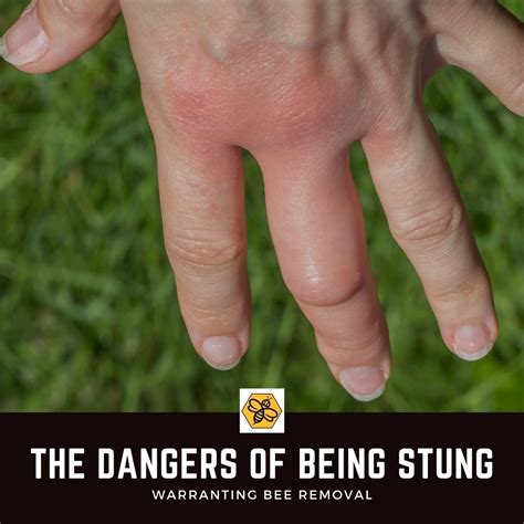 When should I be worried about a bee sting reaction?