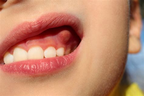 When should I be worried about a lump in my mouth?